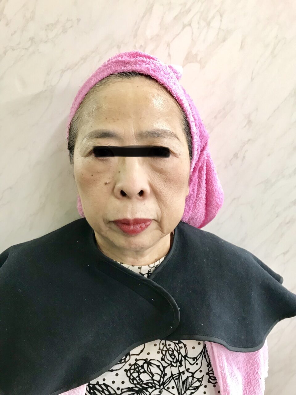 曽於市｜70代女性｜頭皮ケアで見た目の印象が変化した事例after