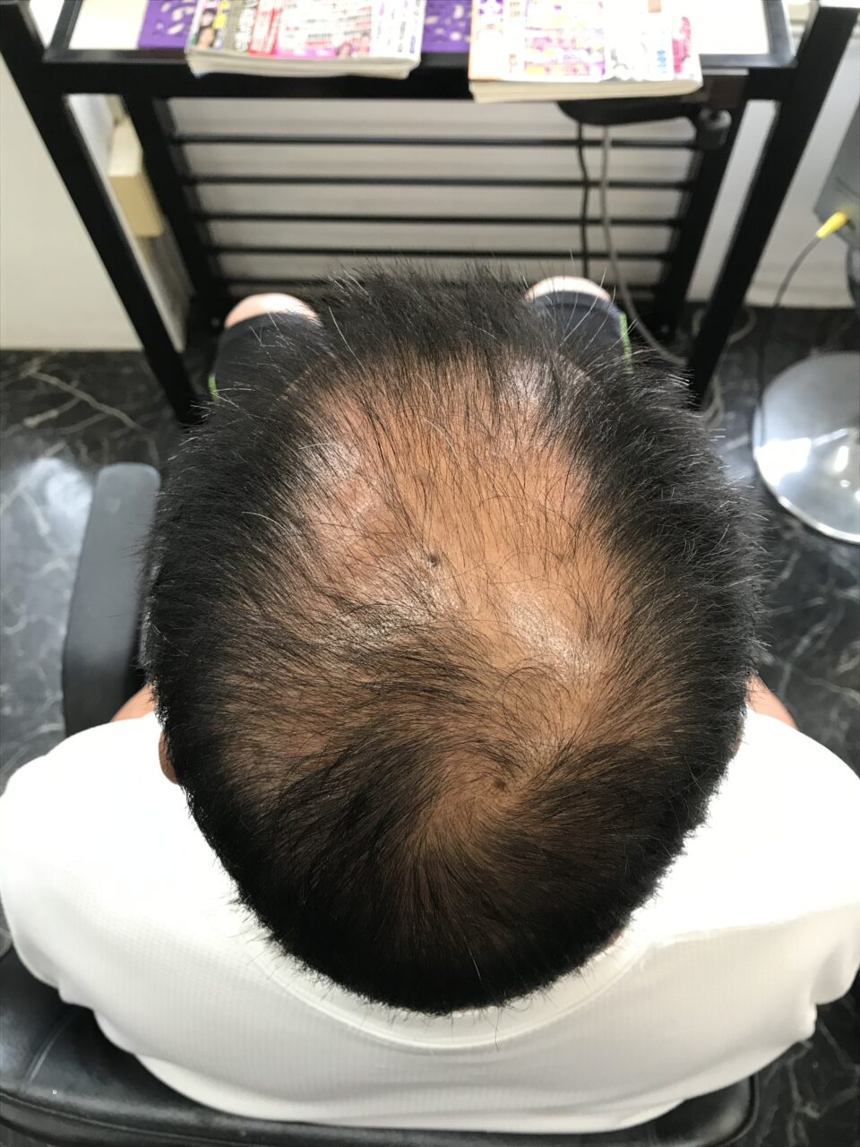 曽於市｜60代男性｜頭頂部の印象が変化した事例before