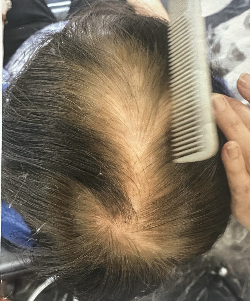 霧島市｜70代女性｜頭皮洗浄3日間で印象が変化した事例before(ボリュームダウンのお悩み事例)