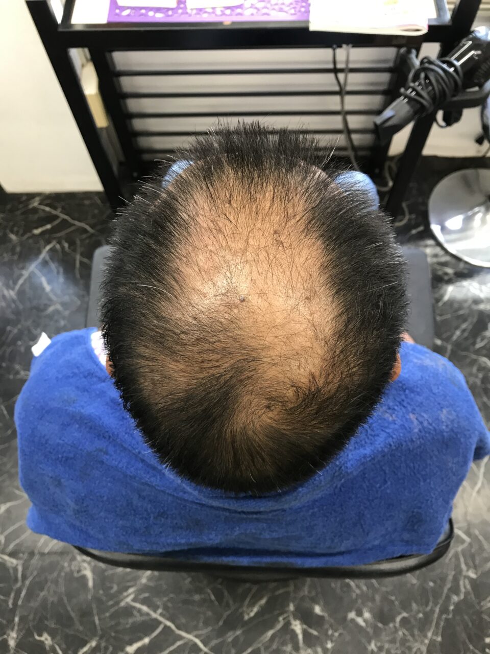 曽於市｜60代男性｜頭頂部の印象が変化した事例before