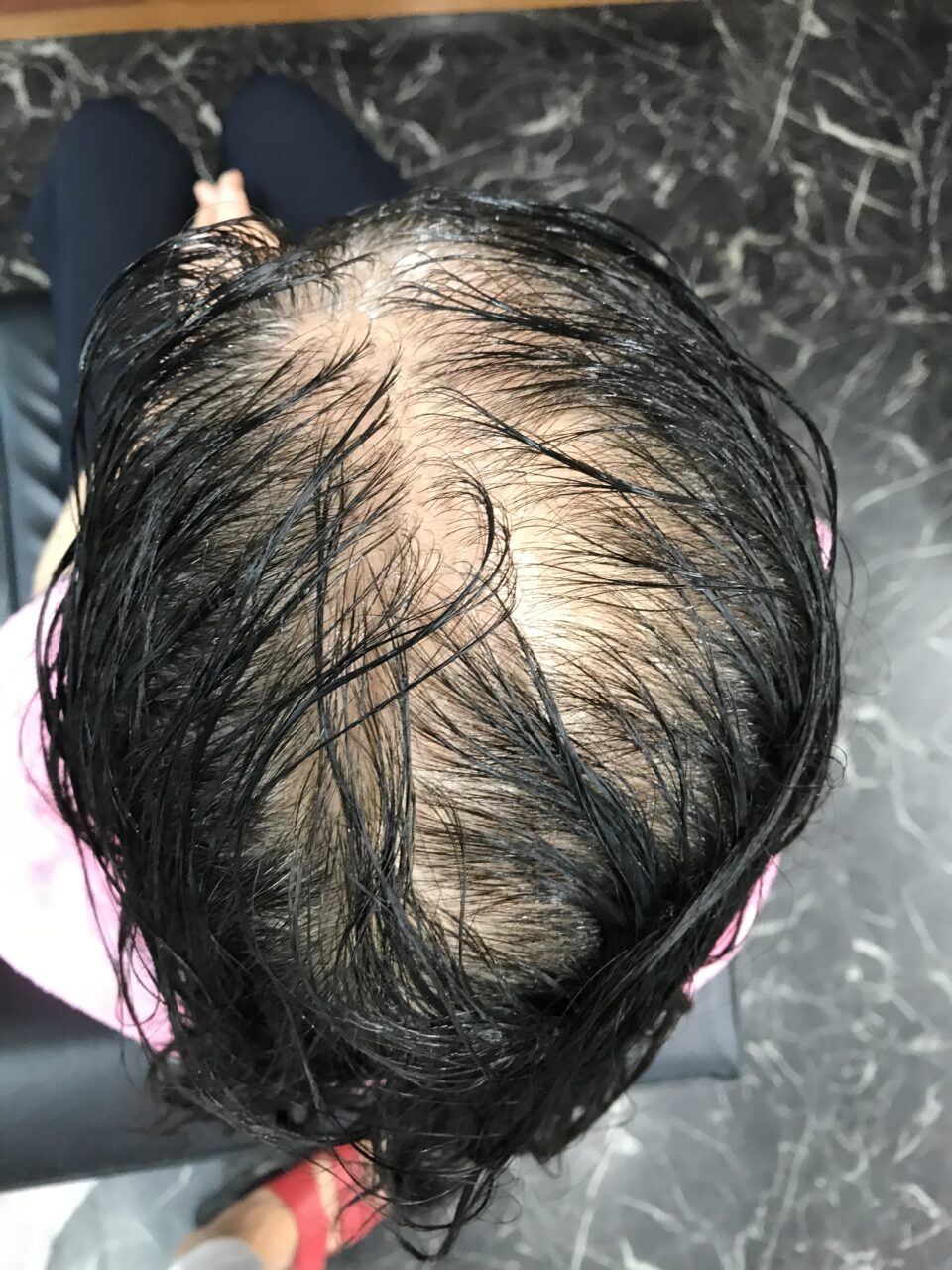 70代女性のボリューム感のお悩みと頭皮ケア事例
