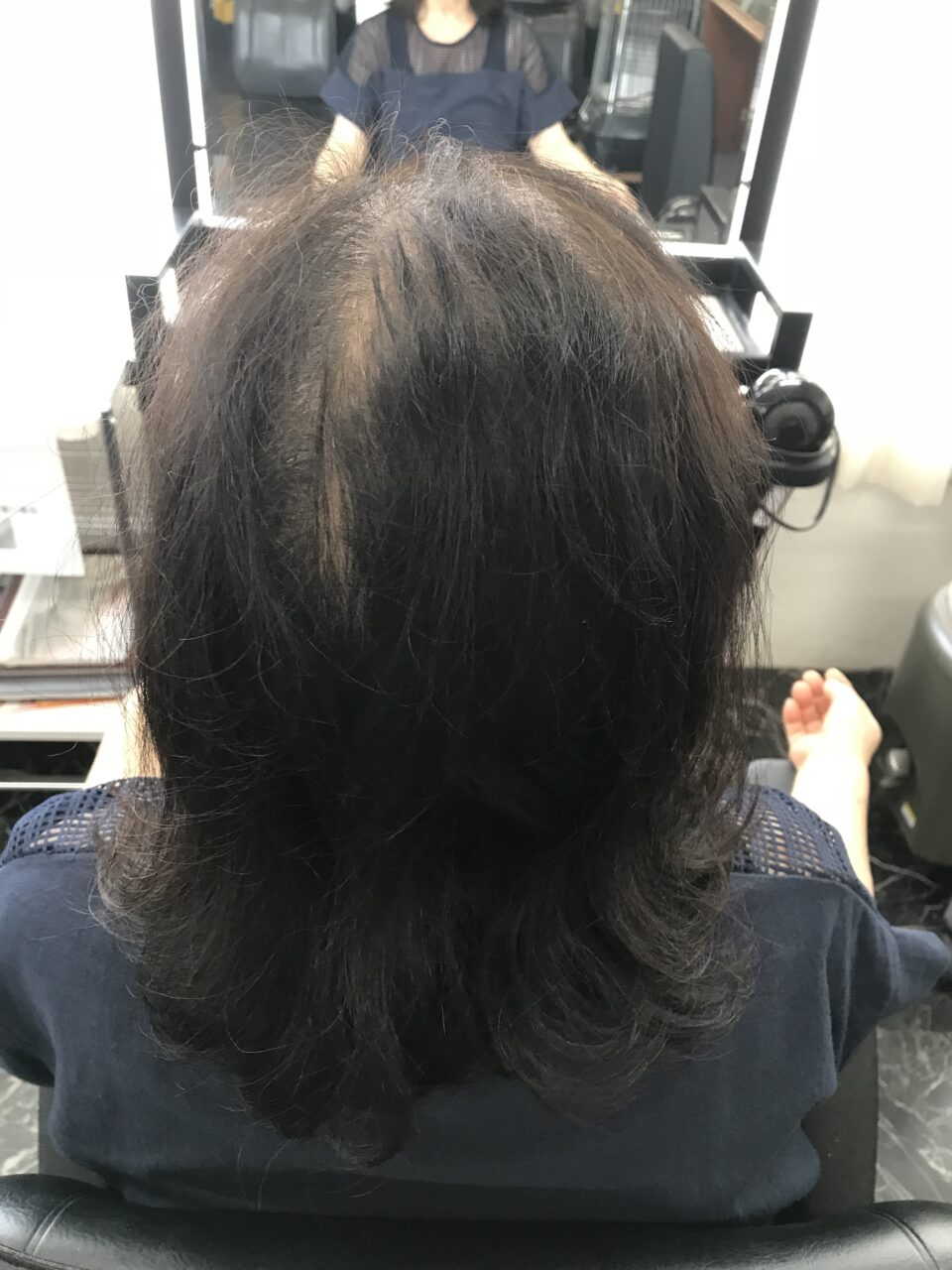70代女性のボリューム感のお悩みと頭皮ケア事例