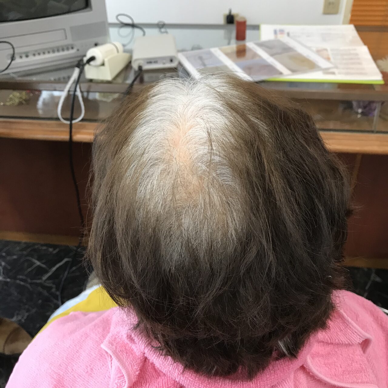 曽於市｜80代女性｜白髪とグレーヘアーへ移行中の頭皮ケア事例