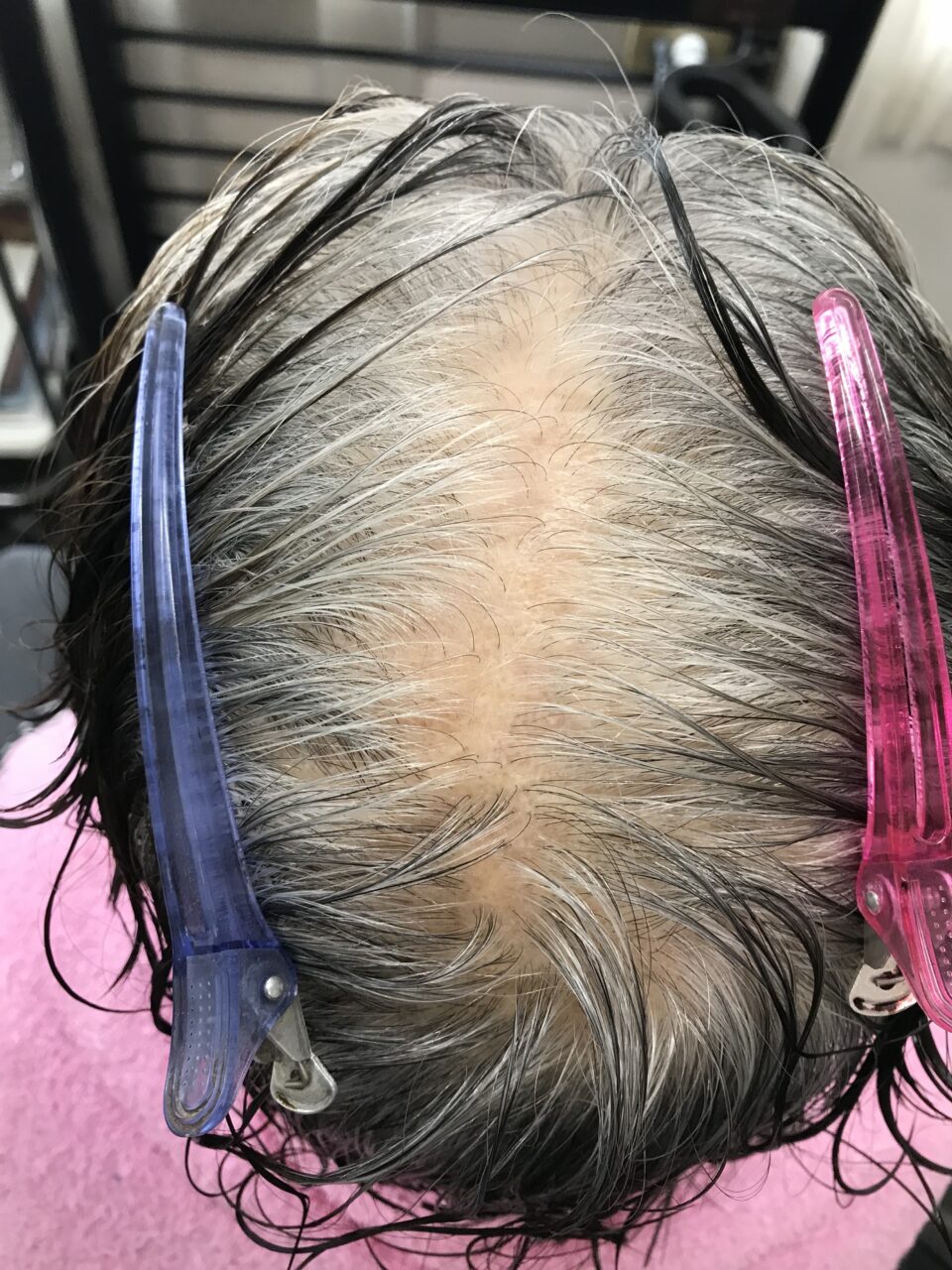 曽於市｜80代女性｜白髪とグレーヘアーへ移行中の頭皮ケア事例before