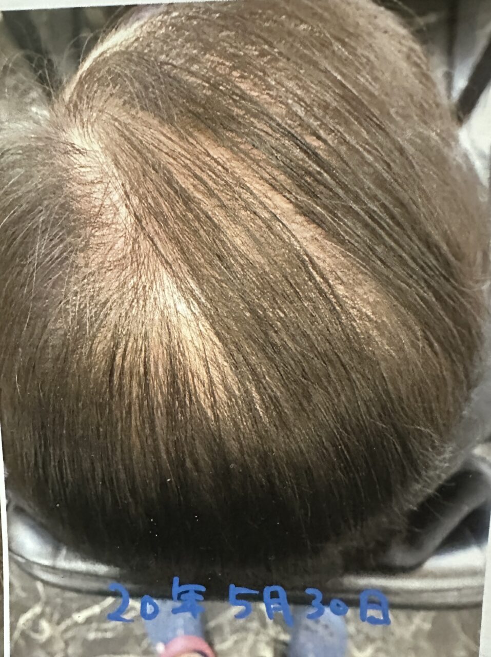 70代女性のボリューム感のお悩みと頭皮ケア事例